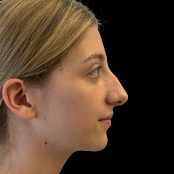 ultrasonic-rhinoplasty-before